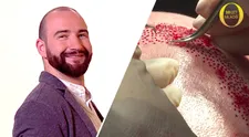 NEBYLO V TV: Exkluzivní záběry z operace. Transplantace vlasů je krvavý zákrok