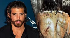 Can Yaman vyděsil fanoušky. Hvězda tureckých telenovel ukázala krvavé šrámy