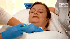 VIDEO: Jak bezbolestně odstranit nevzhledný podbradek?