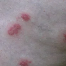 Náhradní manžel Honza se domnívá, že není možné aby byly štípance od štěnic.