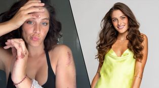 Děsivá nehoda Paulíny z Love Islandu: Spadla ze skútru
