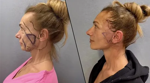 Je to venku! Alice Bendová ukázala tvář po faceliftu