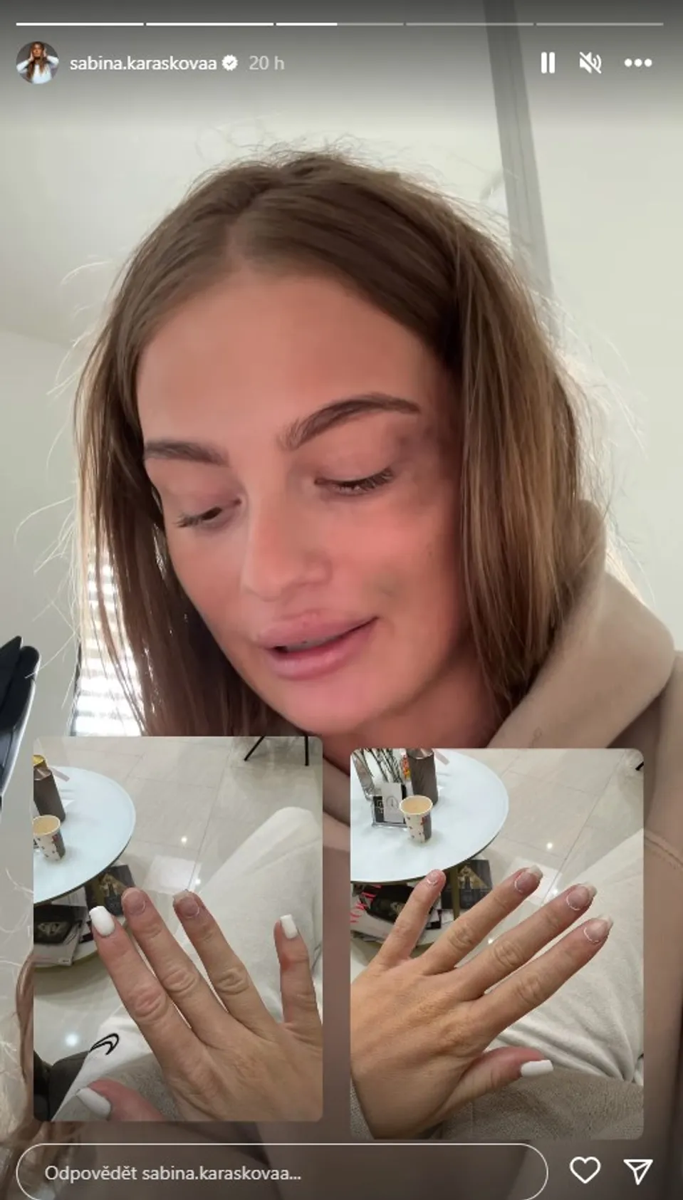 Sabina s modřinami na obličeji.